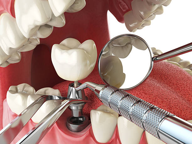 Best Emergency Wisdom Tooth Extraction in Copiague, NY